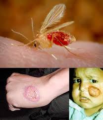 الوصف: Cutaneous Leishmeniasis BAGHDAD BOIL